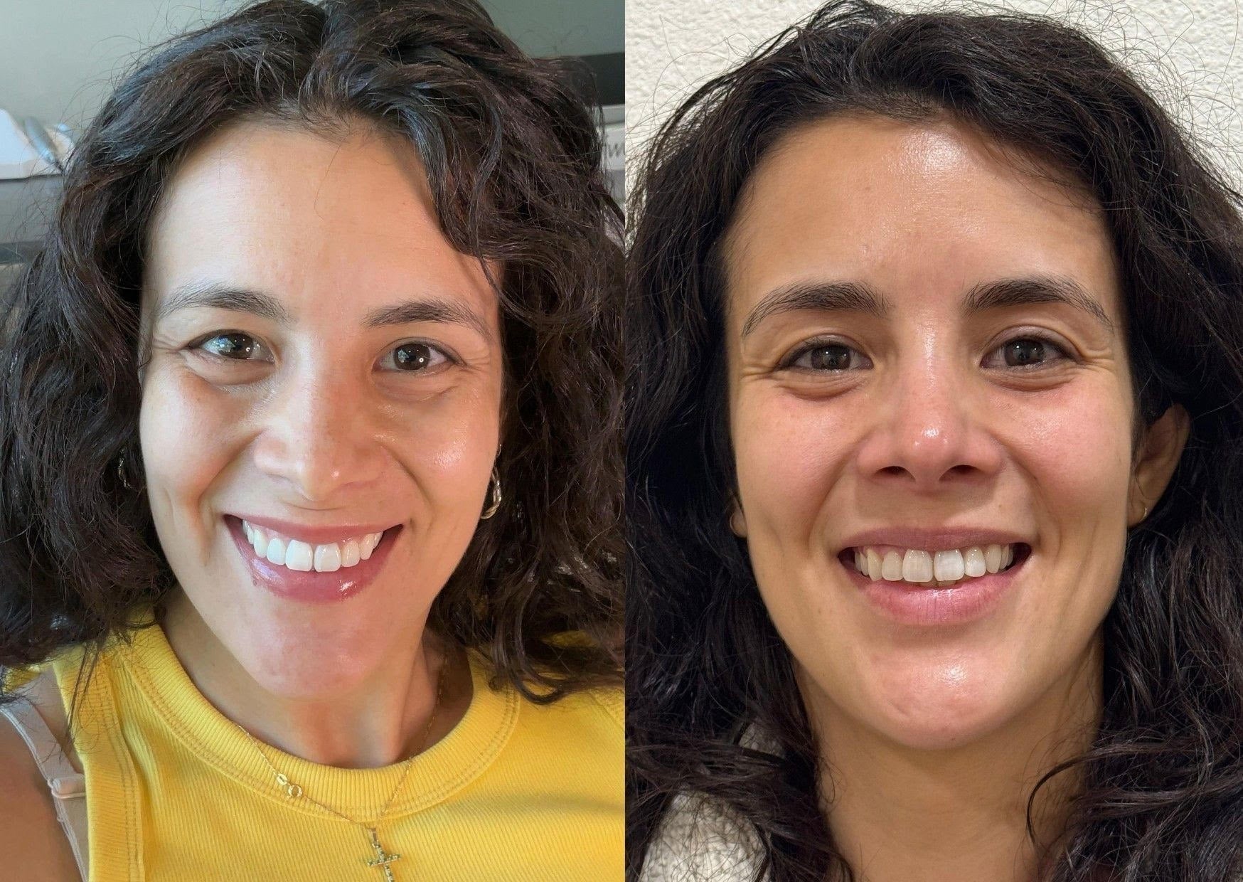 Under-Eye Refresh with PDGF+ - Before & After