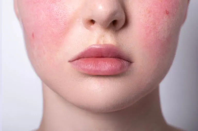 Redness, Rosacea & Broken Capillaries