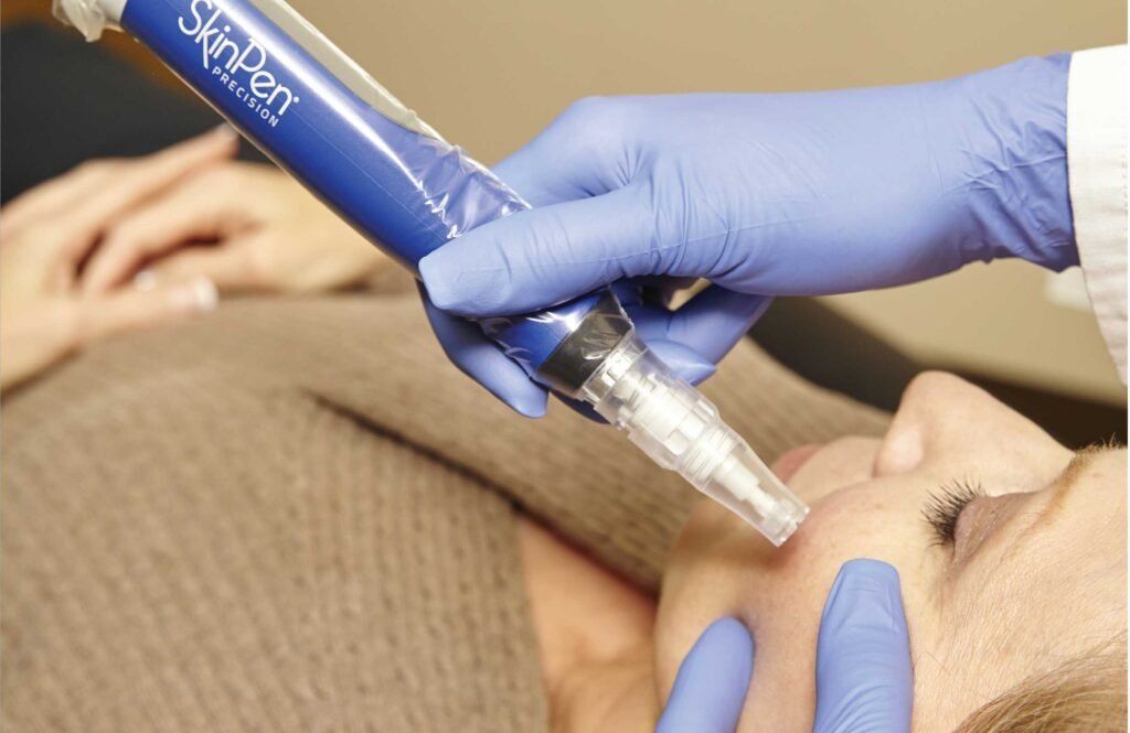 Complete Collagen Induction Therapy Guide: Before & After