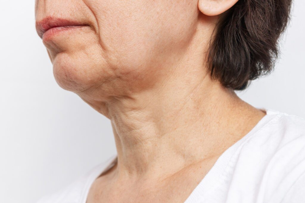 Crepey, loose skin along the jaw and neck