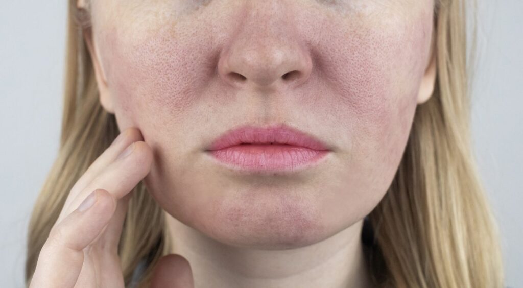 Close view of a woman's cheek with visible redness