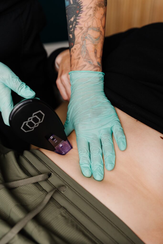 Radiofrequency skin tightening on the abdomen